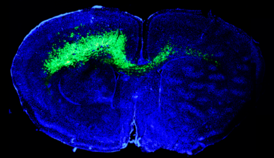 An image of a human brain. The brain is shaded blue with a streak of green passing from the left side to the right to indicate a brain tumor.